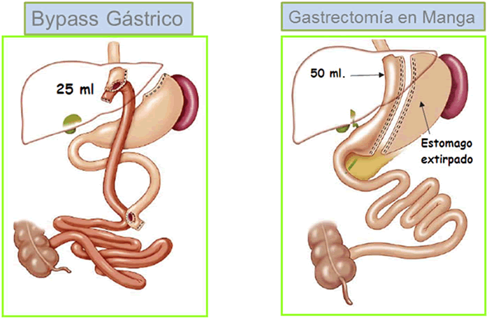 Que cirugía es la mejor para obesidad mórbida