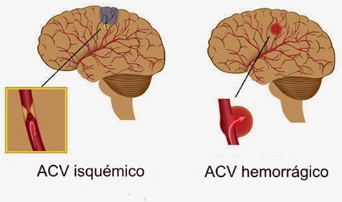 Lesiones vasculares