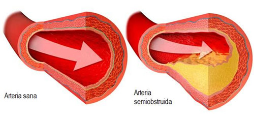 Lesiones vasculares